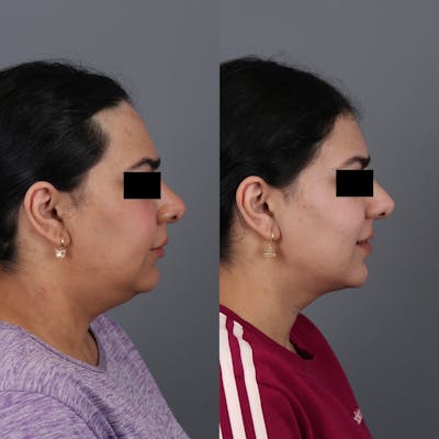 Forehead Reduction Before & After Gallery - Patient 148472138 - Image 4