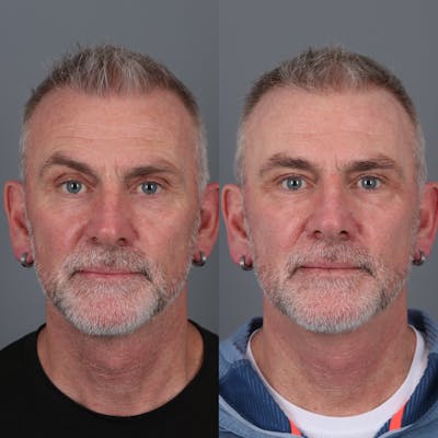 Laser Skin Resurfacing Before & After Gallery - Patient 148472140 - Image 1