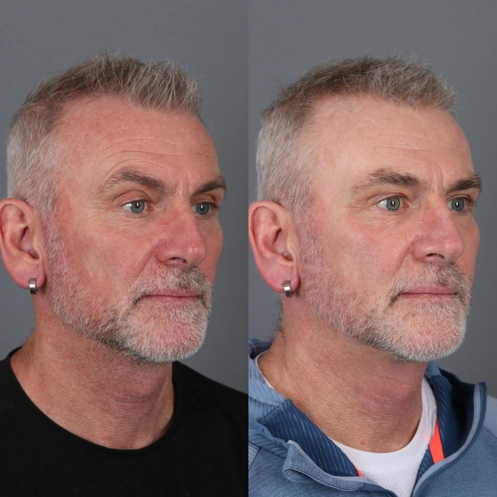 Laser Skin Resurfacing Before & After Gallery - Patient 148472140 - Image 2