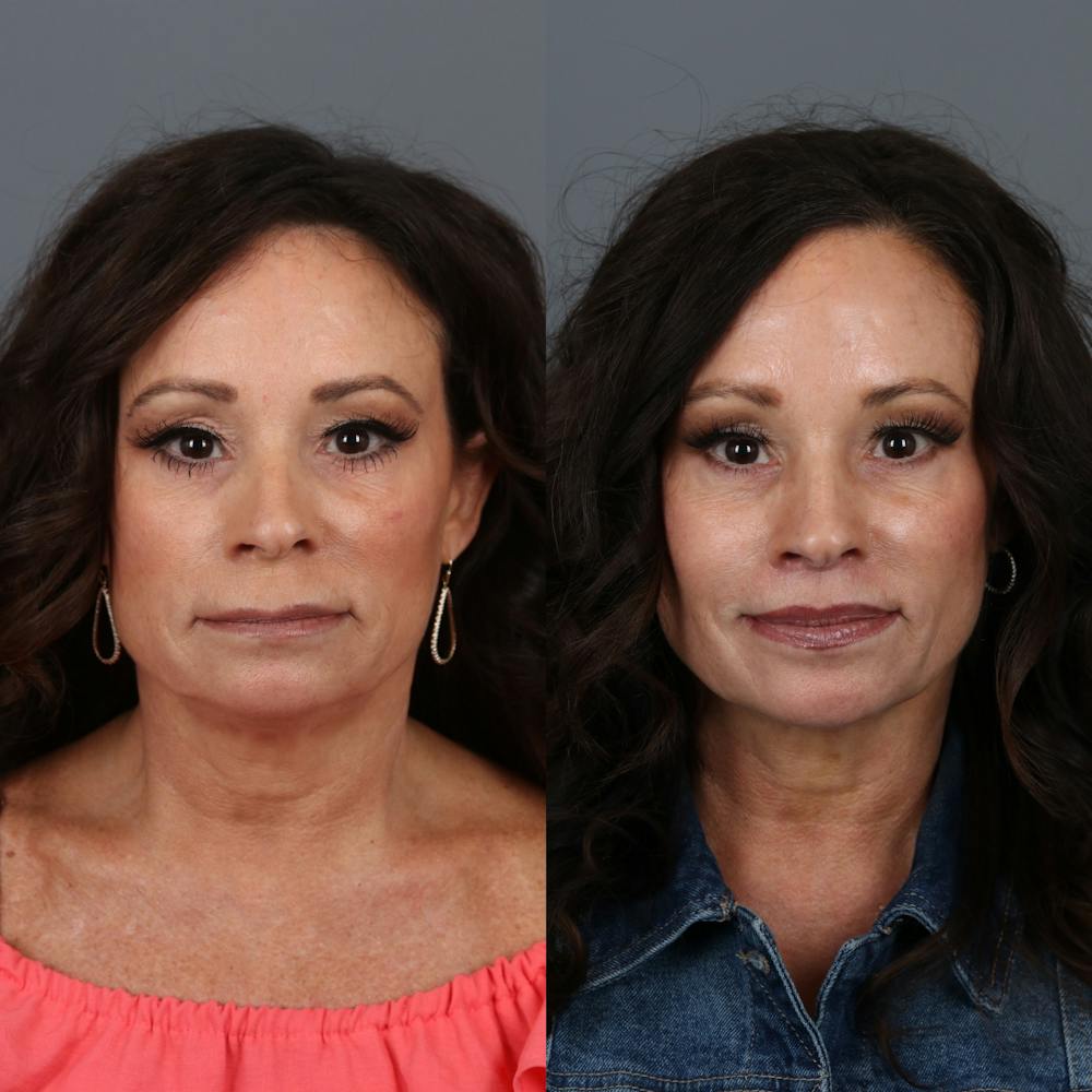 Lip Lift Before & After Gallery - Patient 148472144 - Image 1