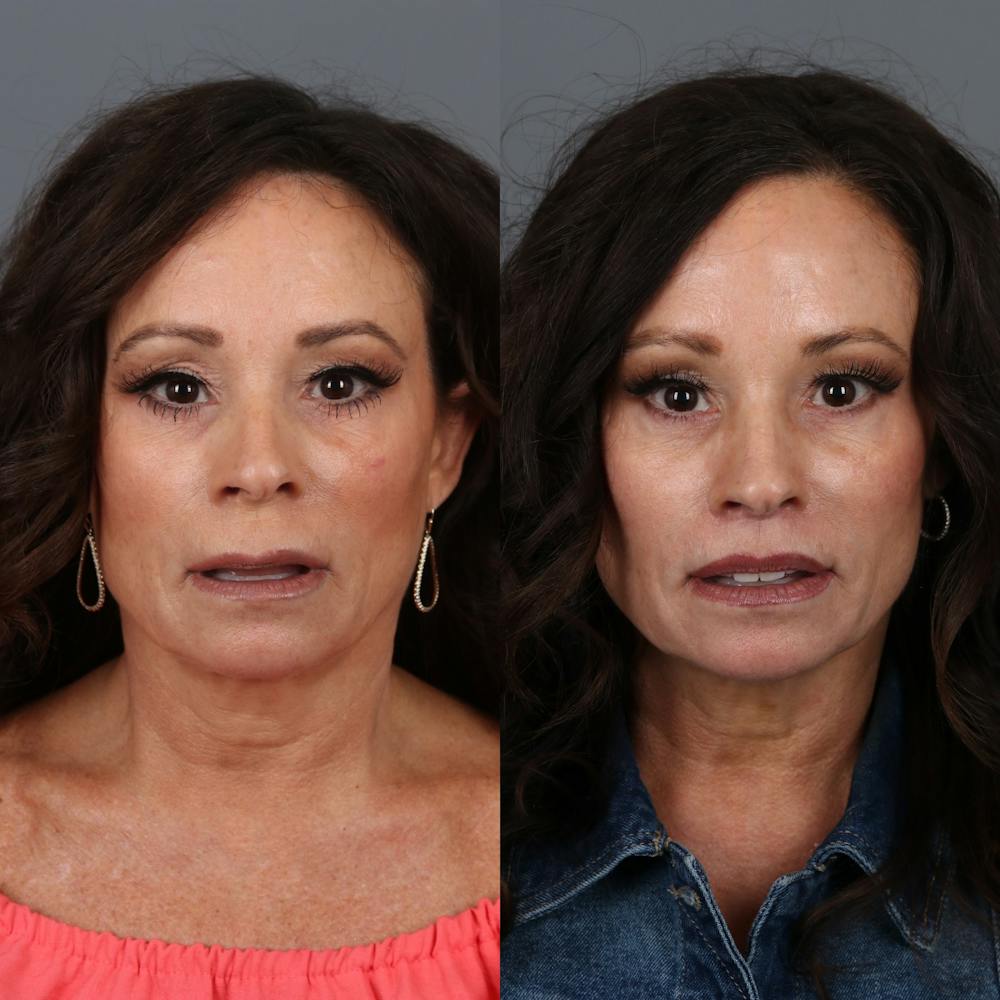 Lip Lift Before & After Gallery - Patient 148472144 - Image 3