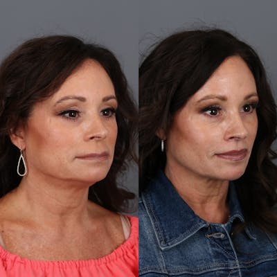 Lip Lift Before & After Gallery - Patient 148472144 - Image 4