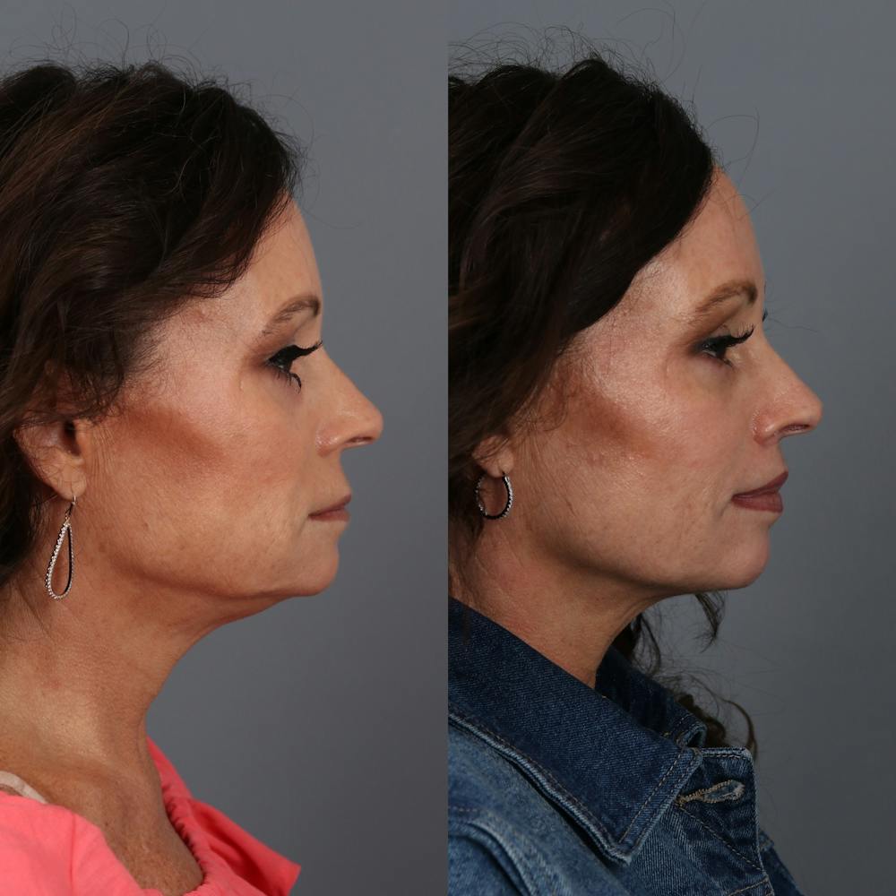 Lip Lift Before & After Gallery - Patient 148472144 - Image 5