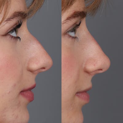 Liquid Rhinoplasty Before & After Gallery - Patient 148757853 - Image 2