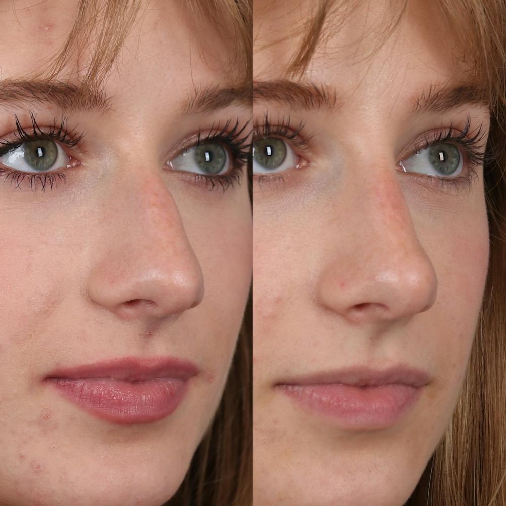 Liquid Rhinoplasty Before & After Gallery - Patient 148757853 - Image 3