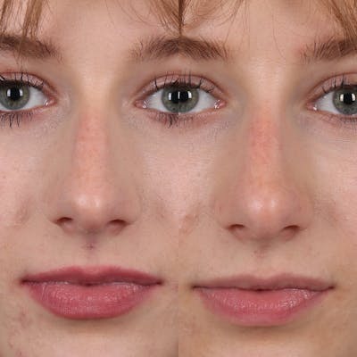 Liquid Rhinoplasty Before & After Gallery - Patient 148757853 - Image 4