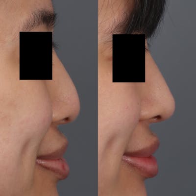 Liquid Rhinoplasty Before & After Gallery - Patient 148757856 - Image 1