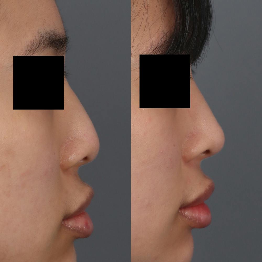 Liquid Rhinoplasty Before & After Gallery - Patient 148757856 - Image 2