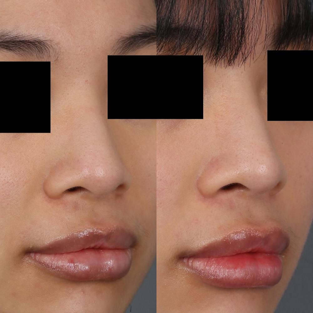 Liquid Rhinoplasty Before & After Gallery - Patient 148757856 - Image 3