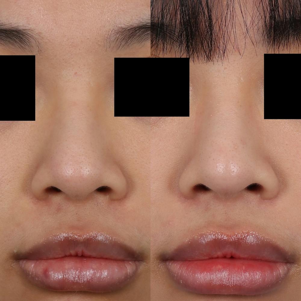 Liquid Rhinoplasty Before & After Gallery - Patient 148757856 - Image 4