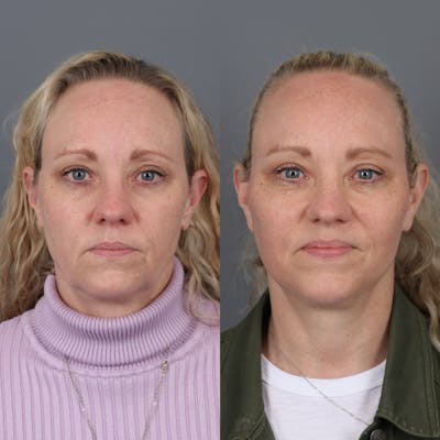 Face & Neck Lift Before & After Gallery - Patient 149279324 - Image 4