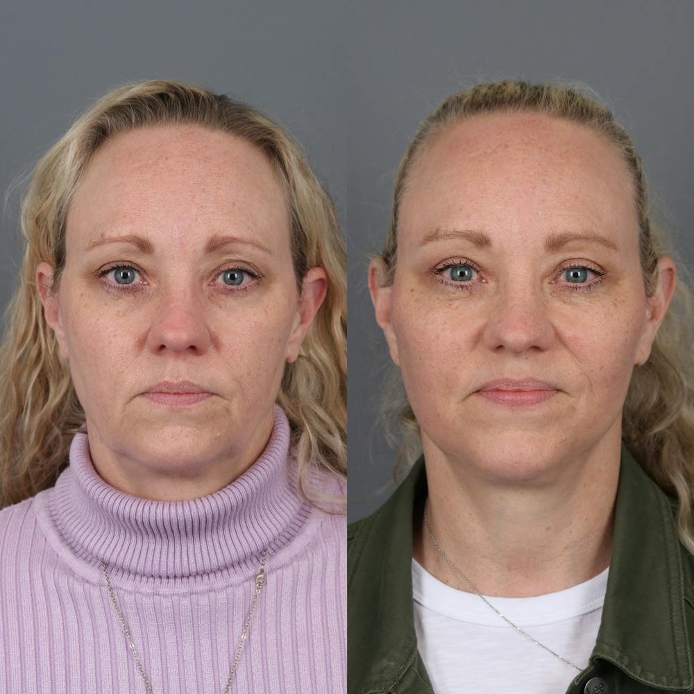 Face & Neck Lift Before & After Gallery - Patient 149279324 - Image 1