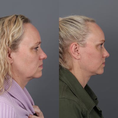 Face & Neck Lift Before & After Gallery - Patient 149279324 - Image 2