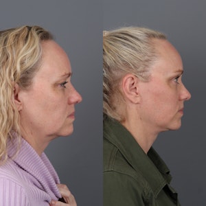 Neck Lift in Portland Before & After Photos