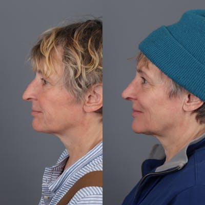 Rhinoplasty Before & After Gallery - Patient 161321970 - Image 1