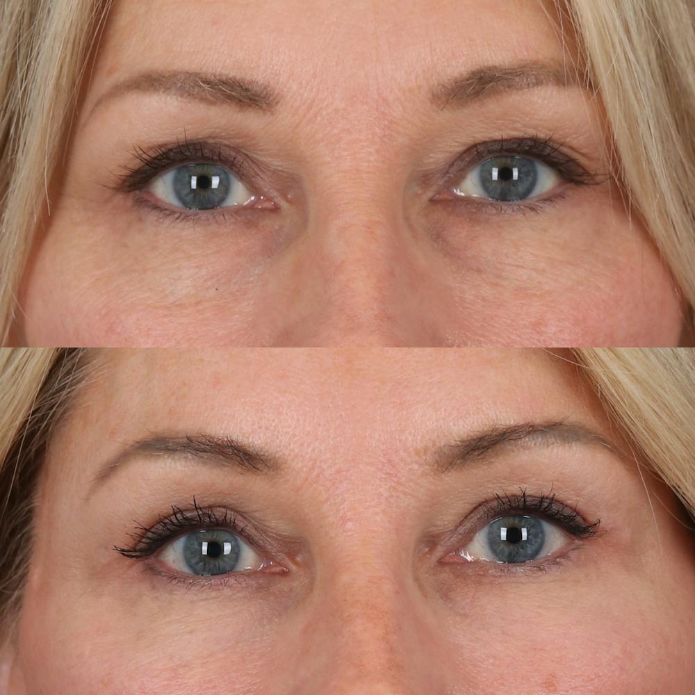 Lower Blepharoplasty Before & After Gallery - Patient 169744035 - Image 1