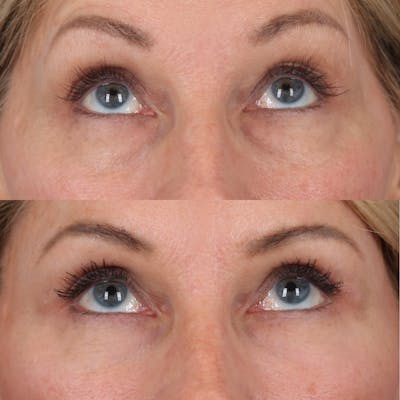Lower Blepharoplasty Before & After Gallery - Patient 169744035 - Image 2