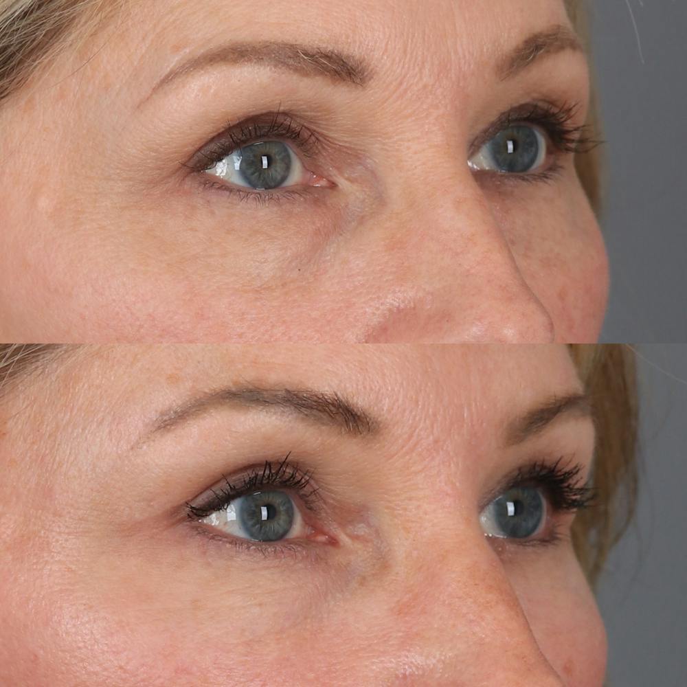 Lower Blepharoplasty Before & After Gallery - Patient 169744035 - Image 3