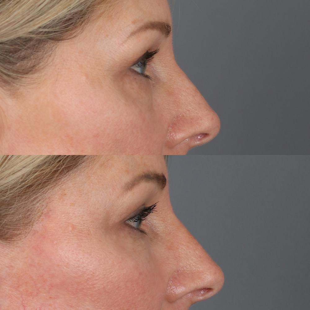 Lower Blepharoplasty Before & After Gallery - Patient 169744035 - Image 4