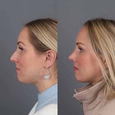 Rhinoplasty Before & After Gallery - Patient 177595438 - Image 1