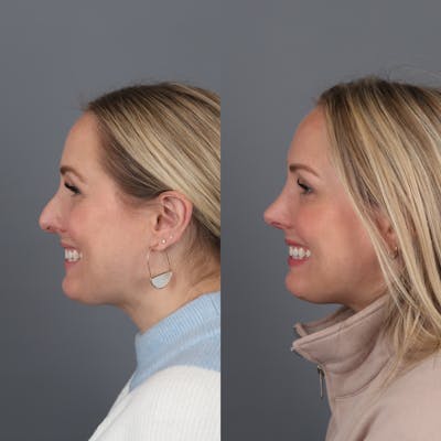 Rhinoplasty Before & After Gallery - Patient 177595438 - Image 2