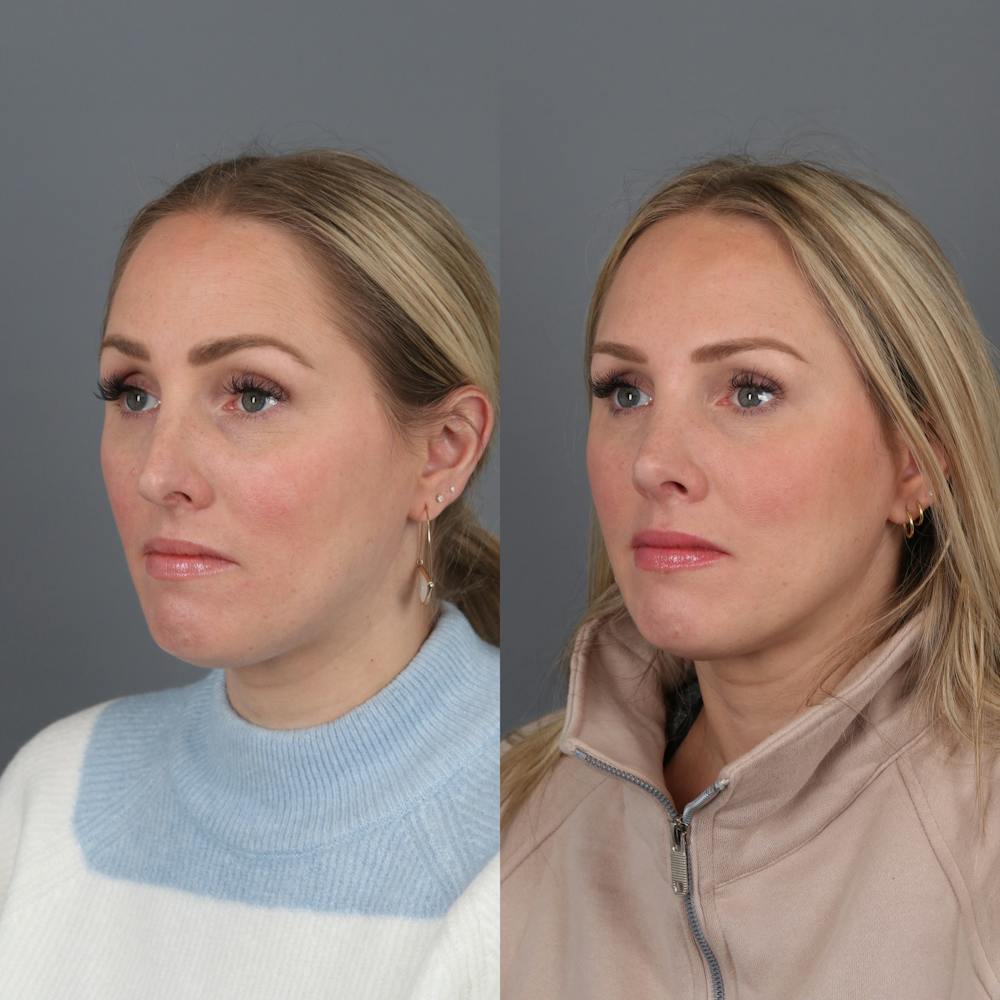 Rhinoplasty Before & After Gallery - Patient 177595438 - Image 3