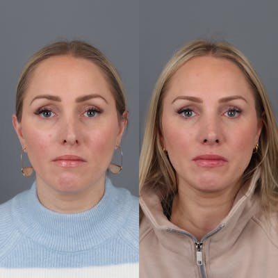Rhinoplasty Before & After Gallery - Patient 177595438 - Image 4