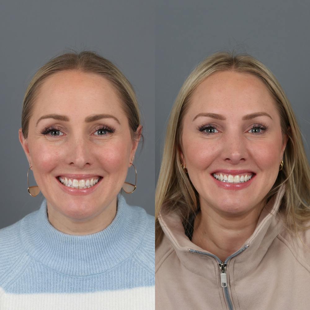 Rhinoplasty Before & After Gallery - Patient 177595438 - Image 5