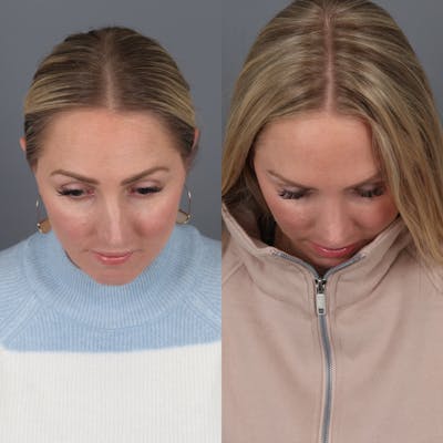 Rhinoplasty Before & After Gallery - Patient 177595438 - Image 6