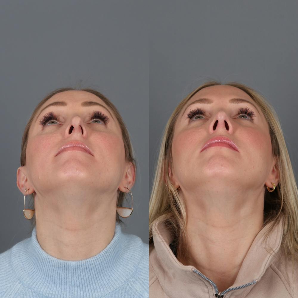 Rhinoplasty Before & After Gallery - Patient 177595438 - Image 7