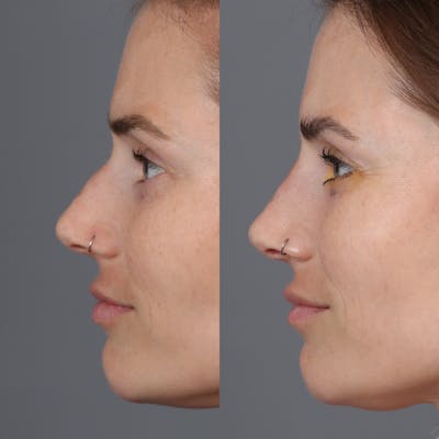 Liquid Rhinoplasty Before & After Gallery - Patient 177620648 - Image 1