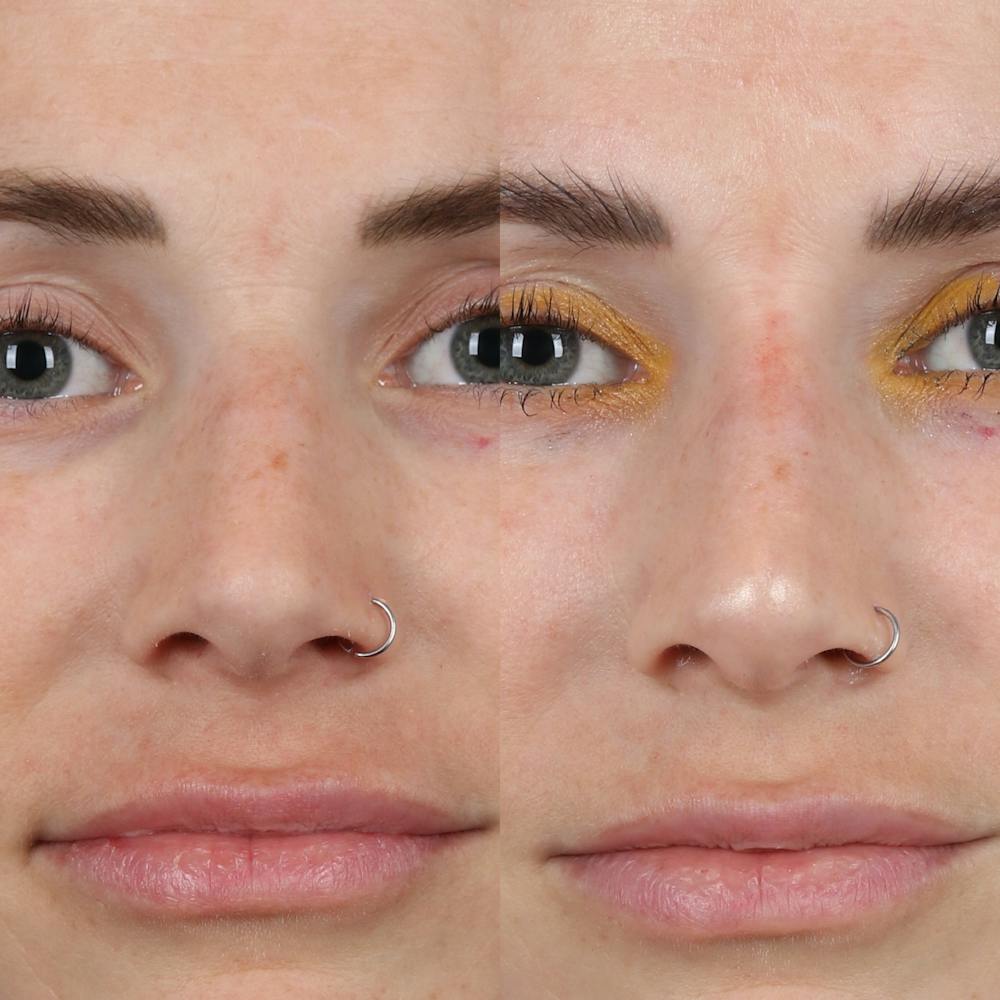 Liquid Rhinoplasty Before & After Gallery - Patient 177620648 - Image 2
