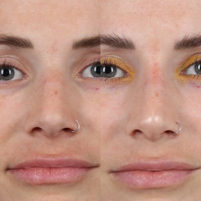 Liquid Rhinoplasty Before & After Gallery - Patient 177620648 - Image 2
