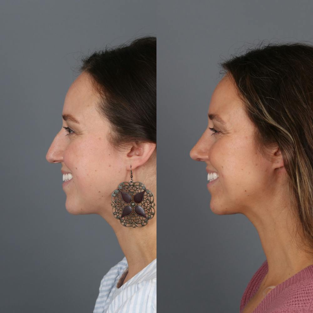 Patient before and after rhinoplasty side view