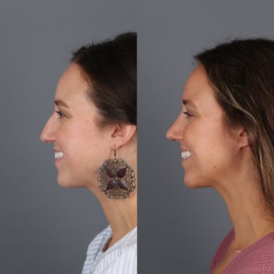 Patient before and after rhinoplasty side view