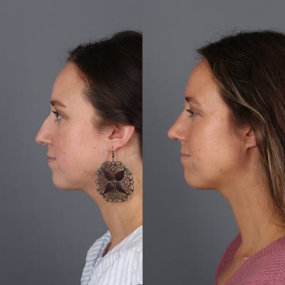 Patient before and after rhinoplasty side view