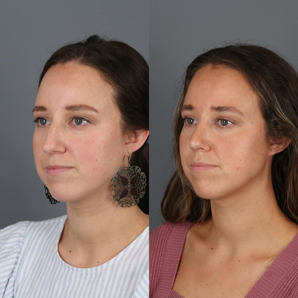 Patient before and after rhinoplasty oblique view