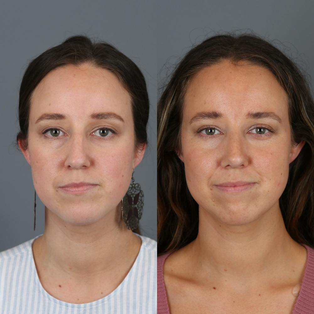 Patient before and after rhinoplasty front view