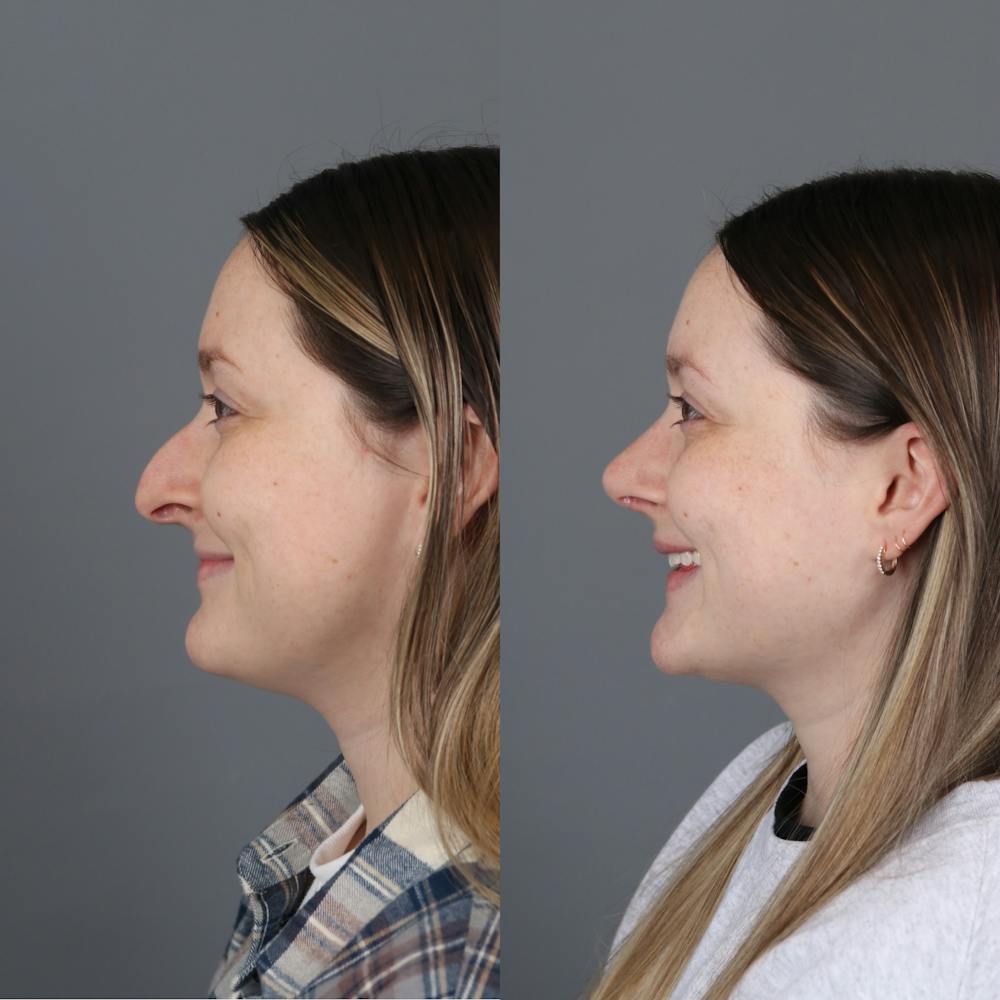 Before and after rhinoplasty side view