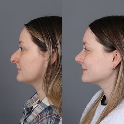 Before and after rhinoplasty side view