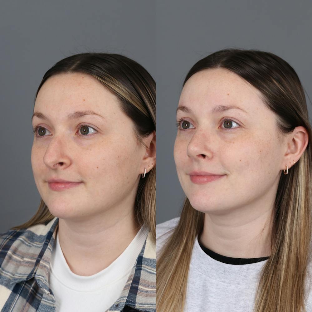 Before and after rhinoplasty oblique view