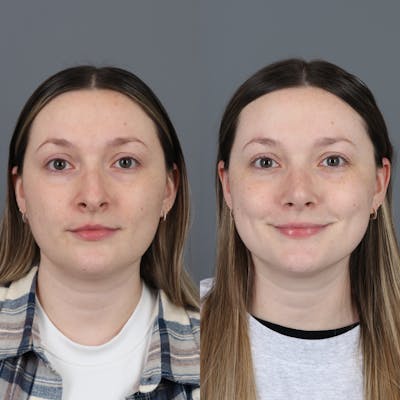 Before and after rhinoplasty front view