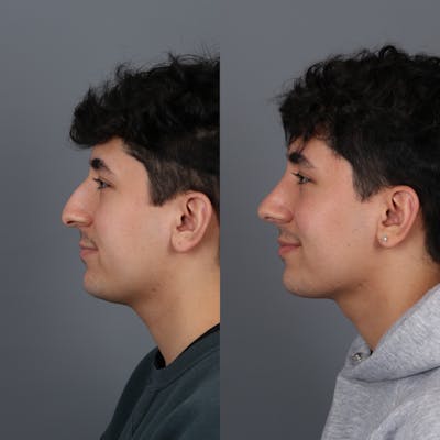 Male patient before and after rhinoplasty side view