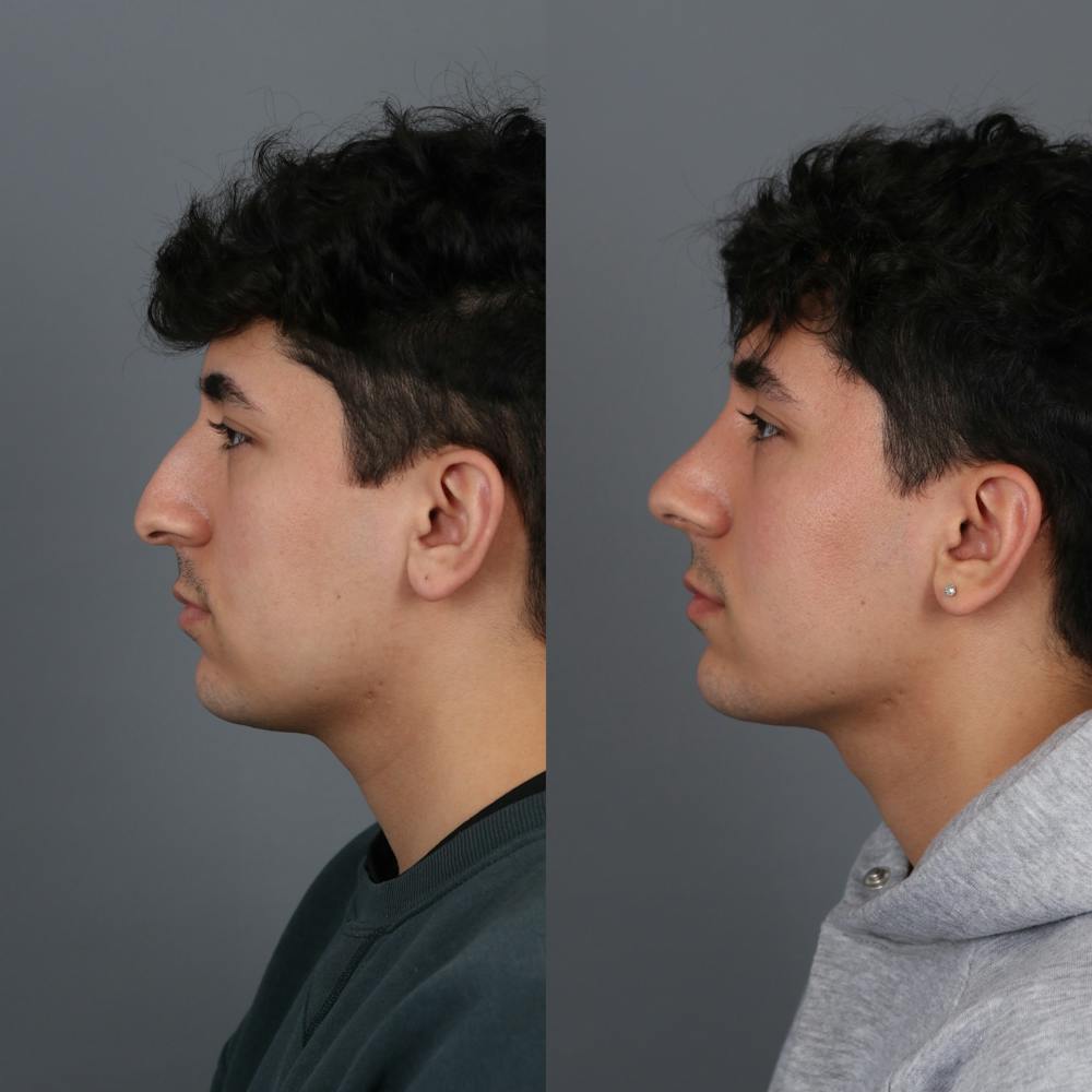 Male patient before and after rhinoplasty side view
