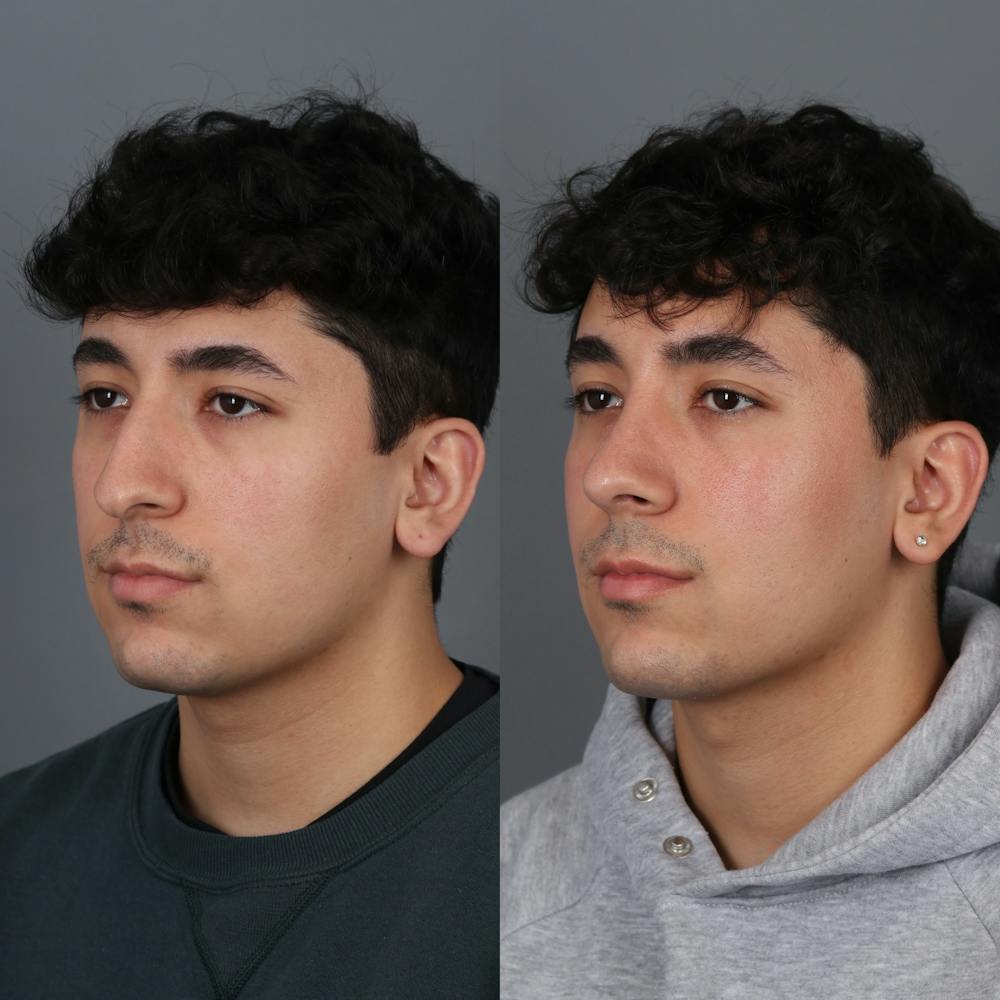 Male patient before and after rhinoplasty oblique view