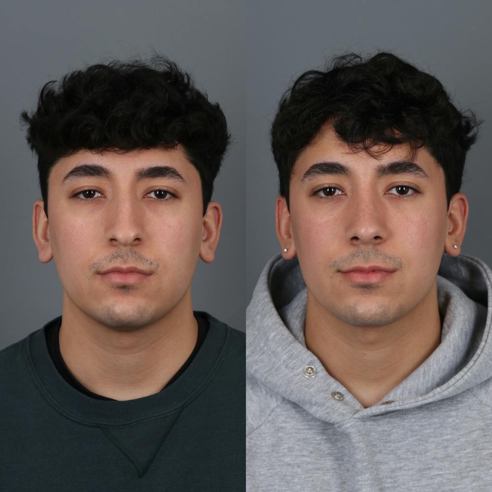 Male patient before and after rhinoplasty front view