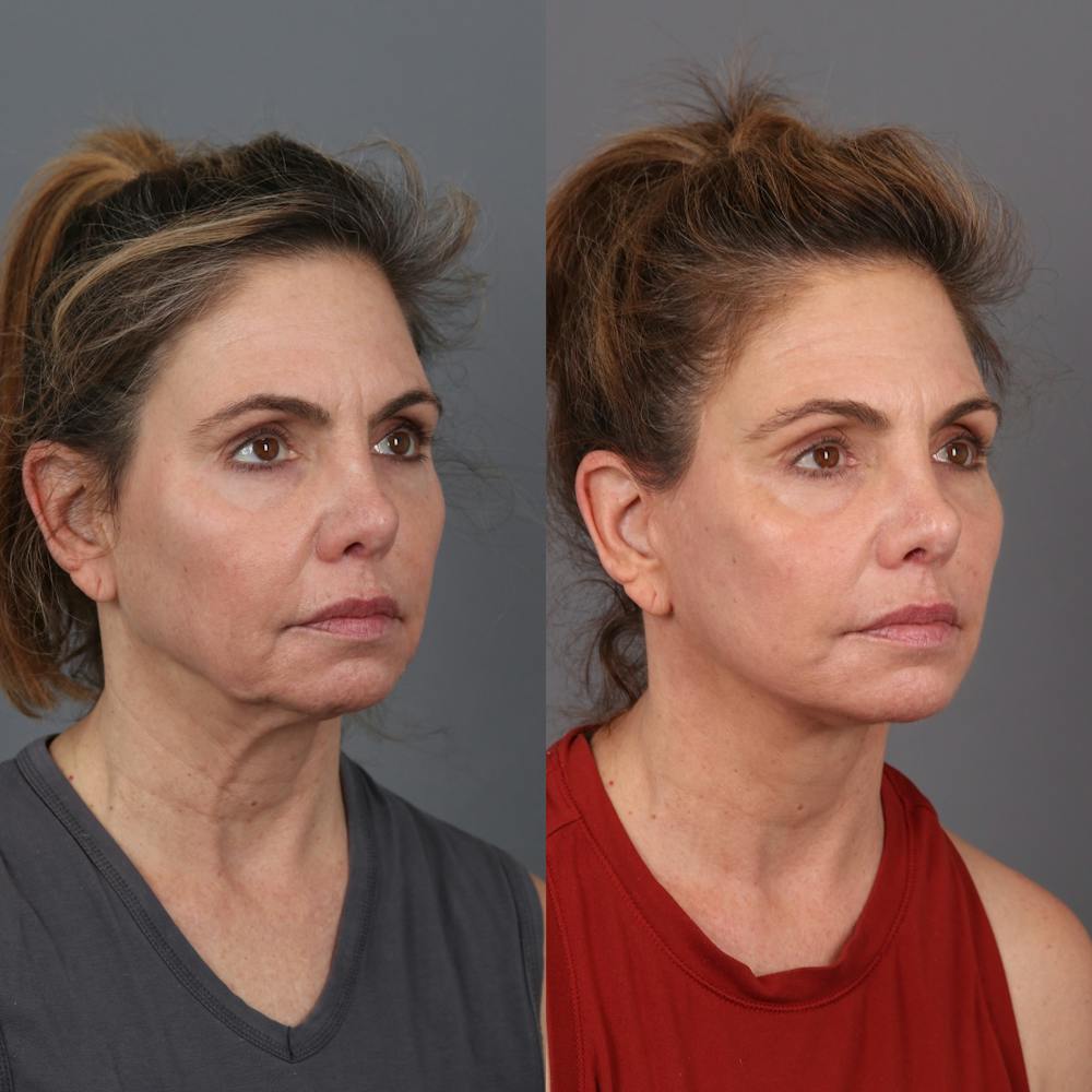 Face & Neck Lift Before & After Gallery - Patient 279782 - Image 1