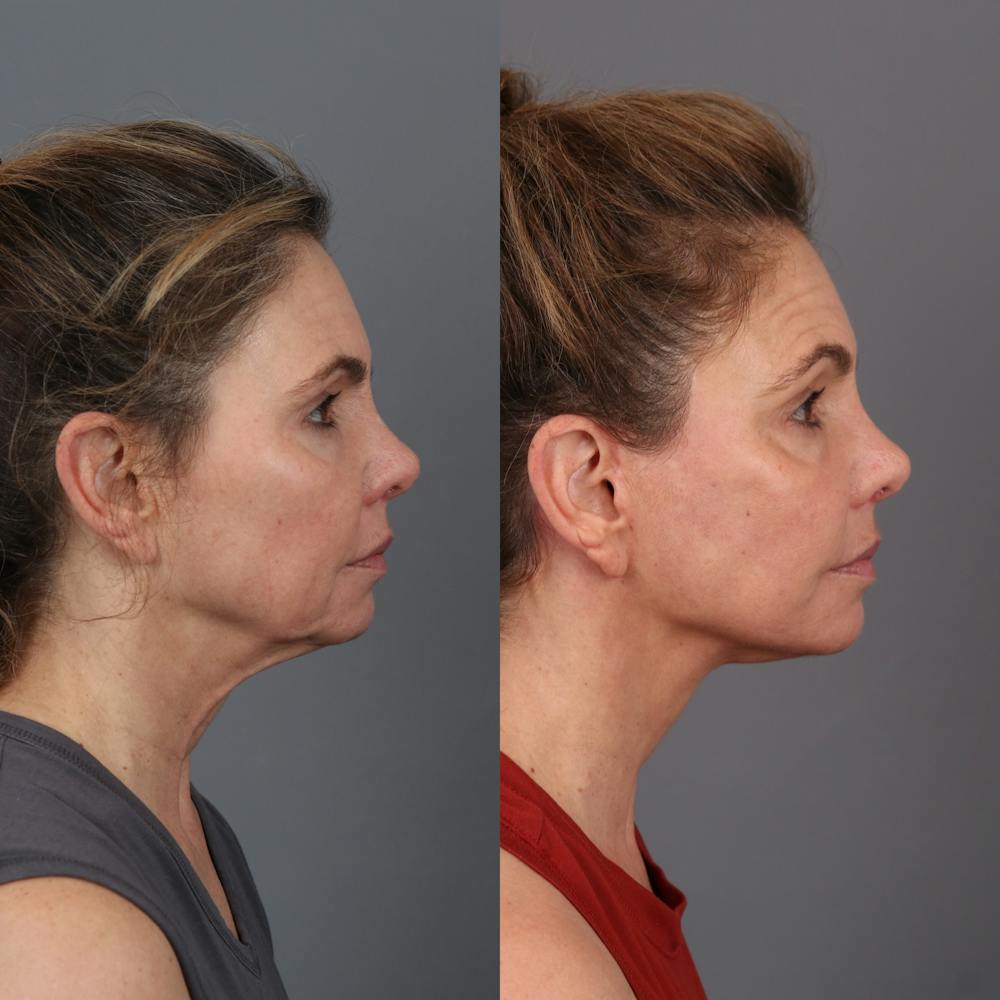 Face & Neck Lift Before & After Gallery - Patient 279782 - Image 2