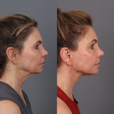 Face & Neck Lift Before & After Gallery - Patient 279782 - Image 2