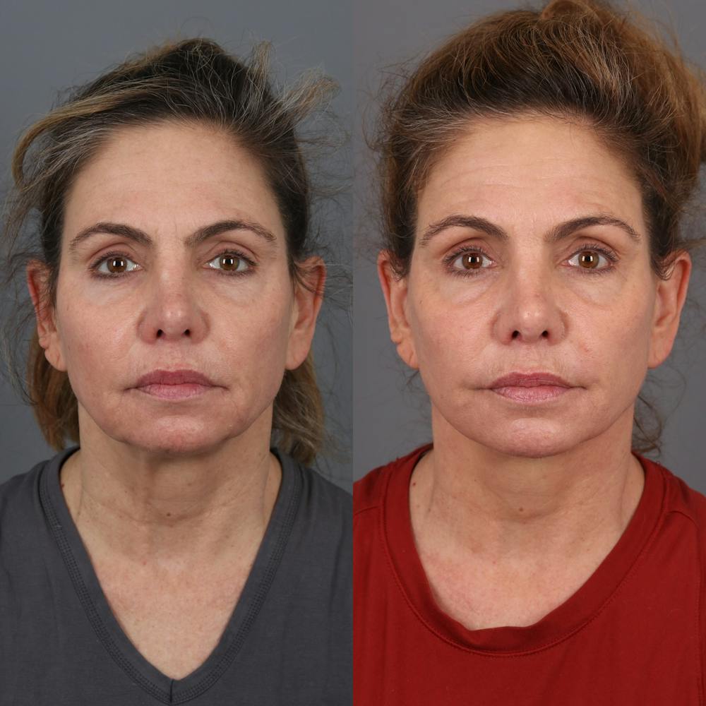 Face & Neck Lift Before & After Gallery - Patient 279782 - Image 3